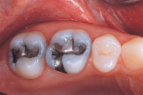 Amalgam fillings- are they bad for me? - Dental at Keys