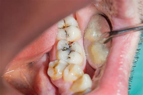 Redefining the Future of Health Services: Hyperdontia Causes Symptoms Prevention And Treatment