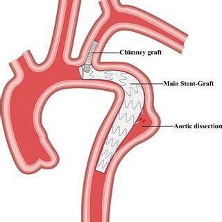 Schematic representation of carotid subclavian bypass and thoracic... | Download Scientific Diagram