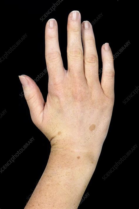 Congenital moles on the hand - Stock Image - C046/1010 - Science Photo Library