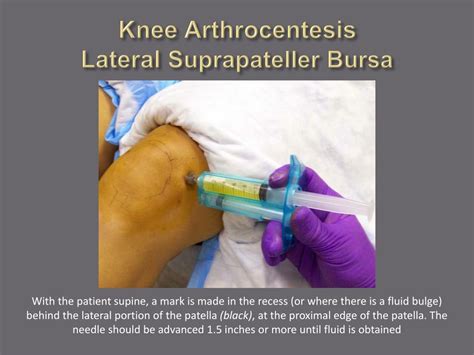 PPT - Arthrocentesis and Joint Injection for the Internist PowerPoint ...