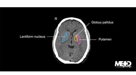 Sagittal Brain Basal Ganglia