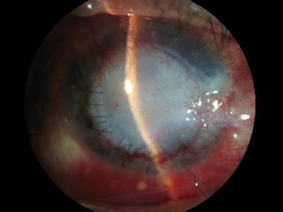 corneal arcus causes | cuzdek