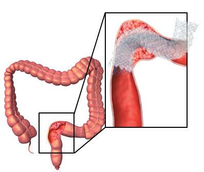 Colonic stent - TwynLay®(NCN) - M.I Tech