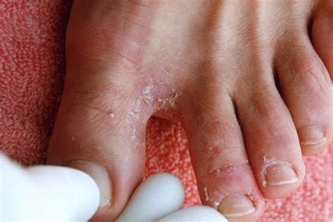 👉 Foot Fungus - Pictures, Types, Causes, Symptoms, Treatment (January 2022)