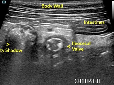 Guess the Pathology - Answer! The Ileocecal valve is the structure this ...