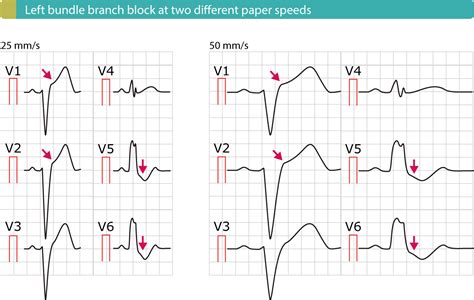 ST segment elevation in acute myocardial ischemia and differential ...