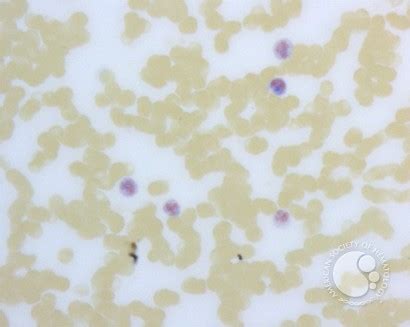 Leukocyte Alkaline Phosphatase Scoring - 1.