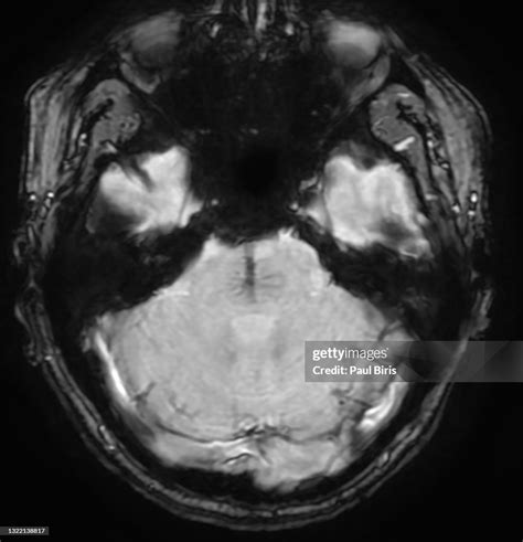 Developmental Venous Anomaly Cerebral Venous Angioma In The Pons Mri ...