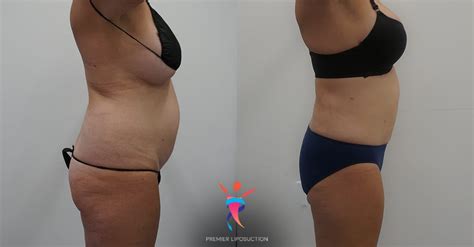 Before and After Liposuction Gallery | See the Results!