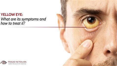 Yellow Eyes Causes And Treatment - Infoupdate.org
