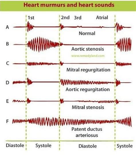 Heart murmurs and heart sounds Nursing Schools In Nyc, Nursing School ...