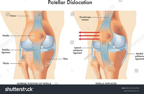 Medical Illustration Symptoms Patellar Dislocation Annotations Stock ...