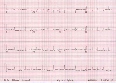 Cardiac Tamponade Ecg