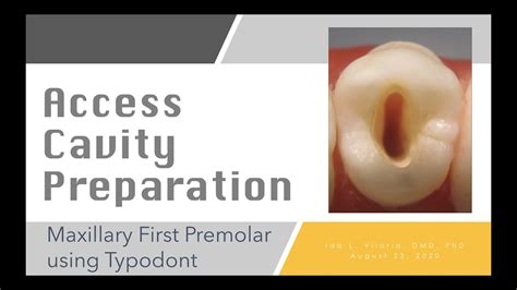 ACCESS CAVITY PREPARATION OF MAXILLARY FIRST PREMOLAR - YouTube