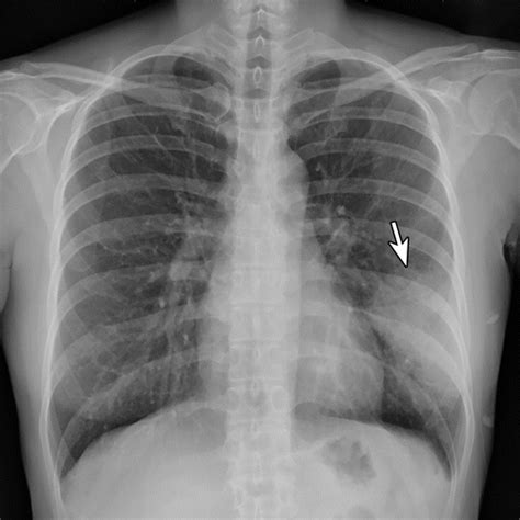 Pneumonia Chest X Ray Findings Lilytool - vrogue.co