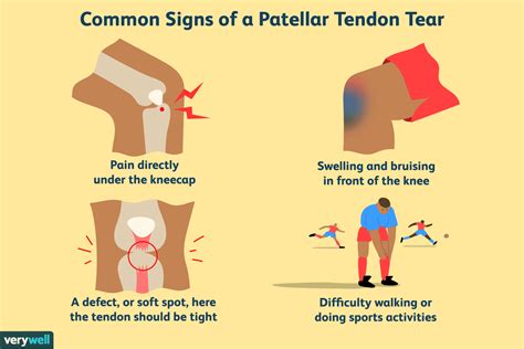 Patellar Tendon Tear: Symptoms, Causes, and Treatment