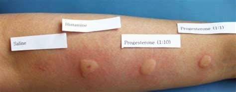 Intradermal testing with progesterone (1: 10, 1: 1) was | Open-i