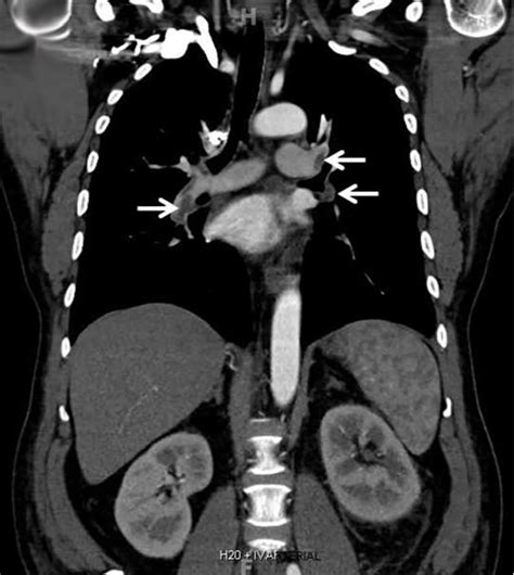 Renal vein thrombosis and pulmonary embolism | Cleveland Clinic Journal of Medicine