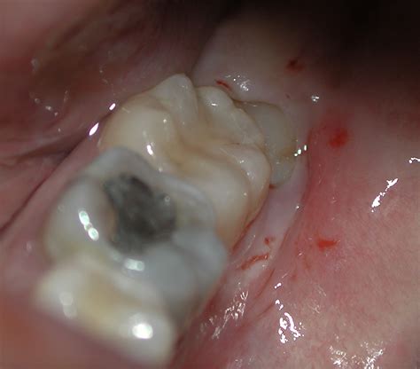 Wisdom Tooth Extraction - U-Dental Clinic