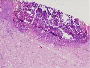 Dermoscopic pattern of Kyrle's disease | Anais Brasileiros de Dermatologia