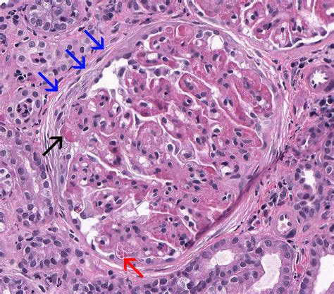 Membranoproliferative Glomerulonephritis – Atlas of Renal Lesions in Proteinuric Dogs