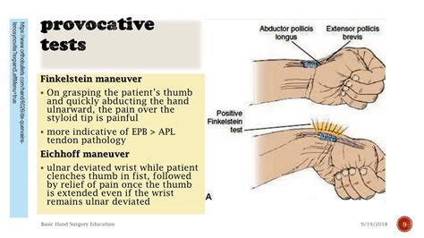 De Quervain's Synovitis