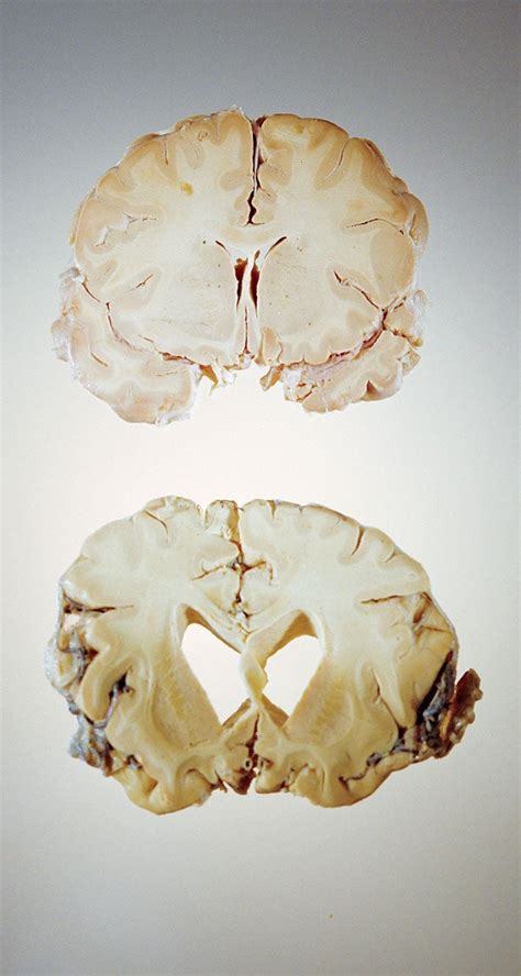 Mad Cow Disease In Humans Brain