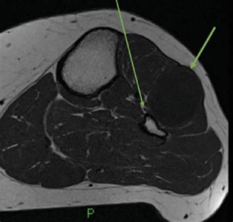 Proximal Tibiofibular Joint Ganglion Cysts - Knee & Sports - Orthobullets