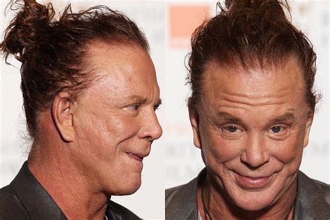 Mickey Rourke Plastic Surgery