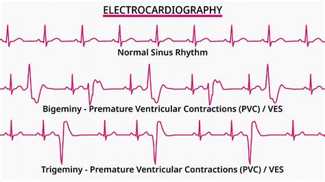 Sinus Rhythm With Unifocal Premature Ventricular Contractions on Sale | vivatumusica.com