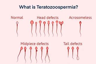 Teratospermia: Causes, Symptoms, and Treatment | A4 Fertility