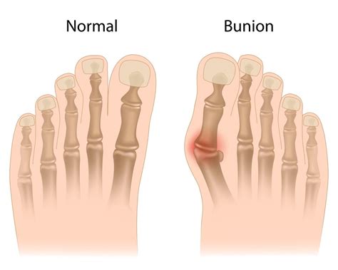 Explainer: what is a bunion and do I need to get mine treated?