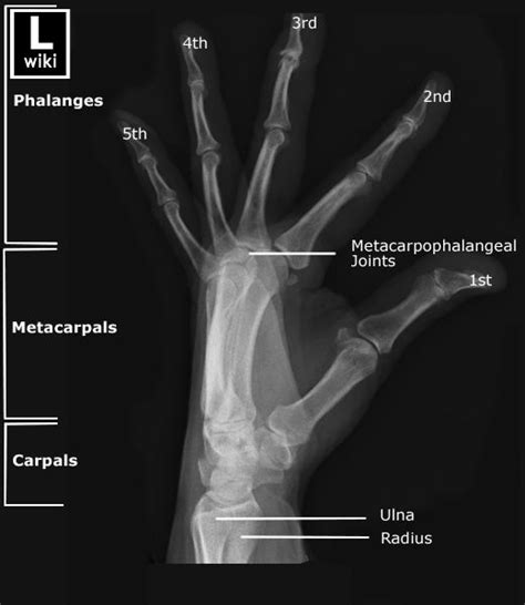 Lateral fanned view of the hand with labels. | Radiology student, Radiology schools, Radiology