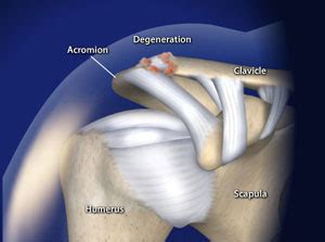 Acromioclavicular (AC) Joint Arthritis