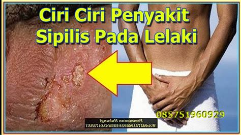 SPILIS : Ciri Ciri Gejala Sipilis Pada Pria - YouTube