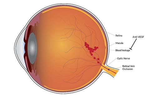 Vision improvement is long-lasting with treatment for blinding blood ...
