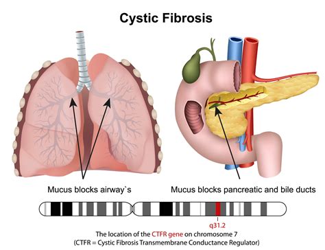 Can Talk Therapy Via Telemedicine Be the Answer for Cystic Fibrosis Patients Suffering from ...