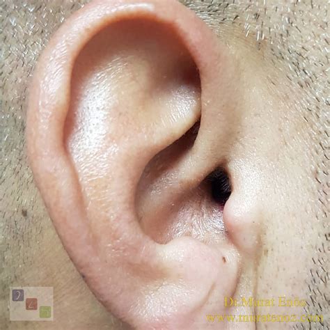 Two Months After Endoscopic Eardrum Repair