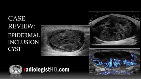 Ultrasound of Epidermal Inclusion Cyst - YouTube