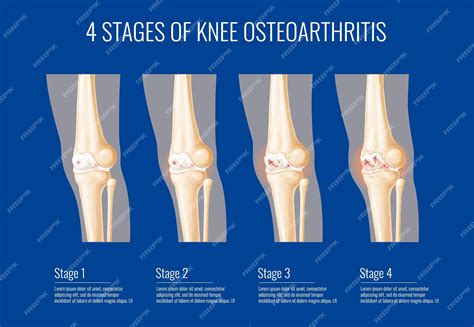 Premium Vector | Knee joint osteoarthritis stages infographics