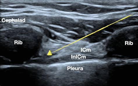 Ultrasound Guided Intercostal Nerve Block – NBKomputer