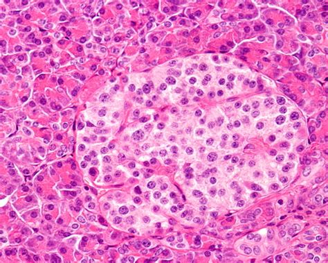 Profiling Human Islet Cells with Laser Capture Microdissection