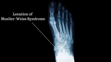 Mueller-Weiss Syndrome explained by a Foot Specialist