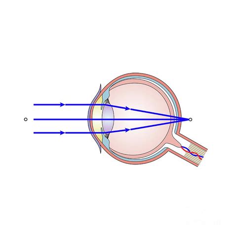 Long-sightedness Photograph by Science Photo Library - Fine Art America