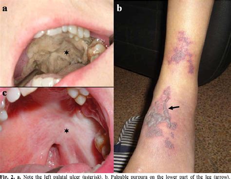 Figure 2 from Wegener's granulomatosis: description of a case with oral manifestation ...