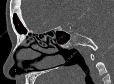 Normal sinuses, CT scan - Stock Image C029/4641 - Science Photo Library