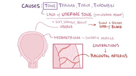 Postpartum hemorrhage: Video, Anatomy & Definition | Osmosis