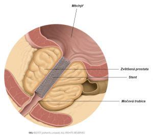 Prostatické stenty - PI CZ