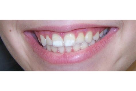 How To Get Rid Of White Spots On Teeth - All You Need Infos